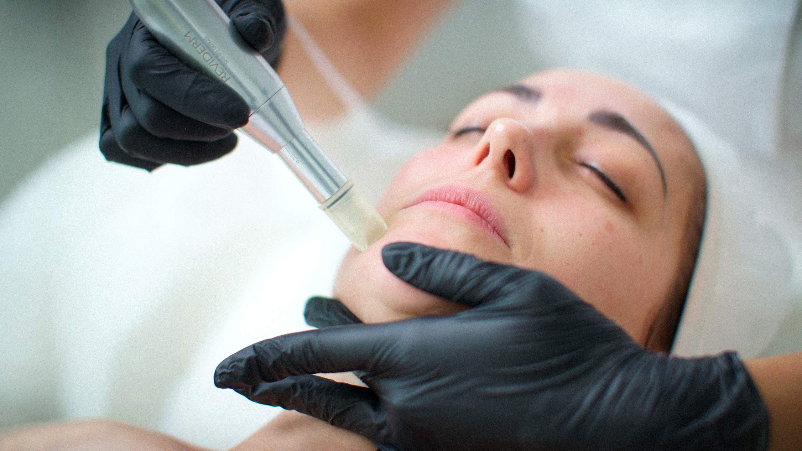 Microneedling