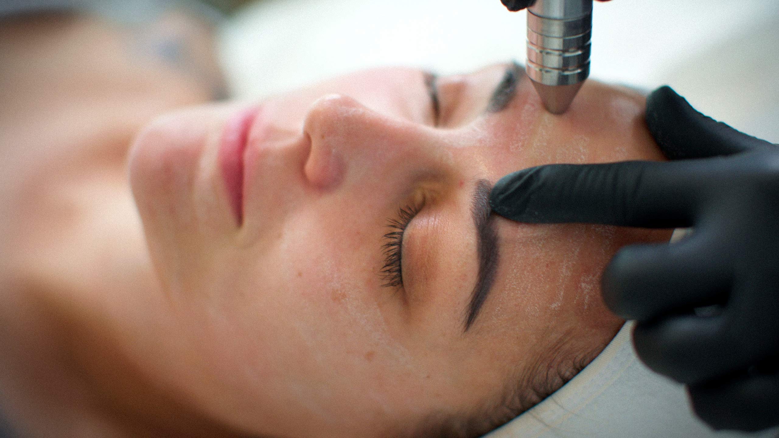 Microdermabrasion