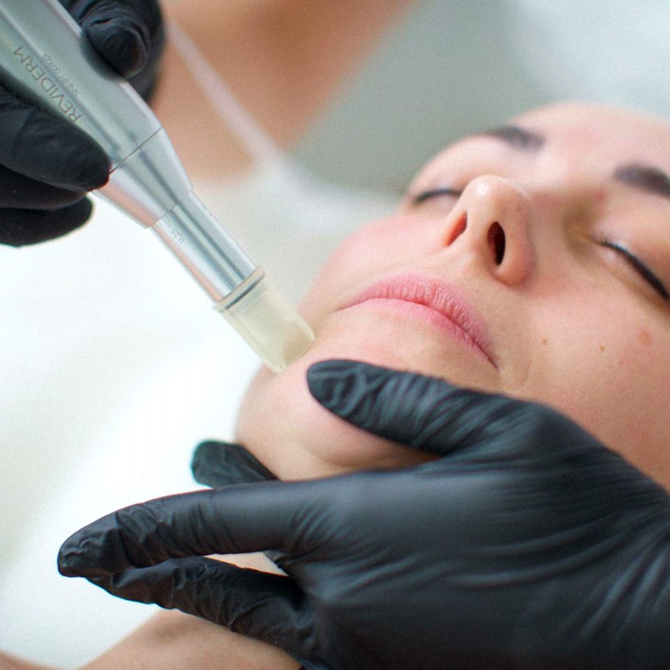 Microneedling