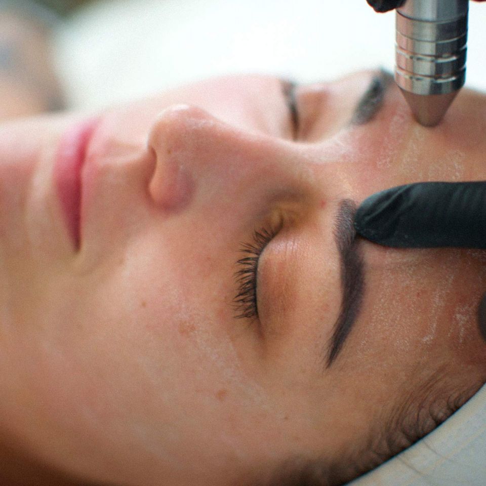 Microdermabrasion