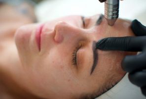 Microdermabrasion